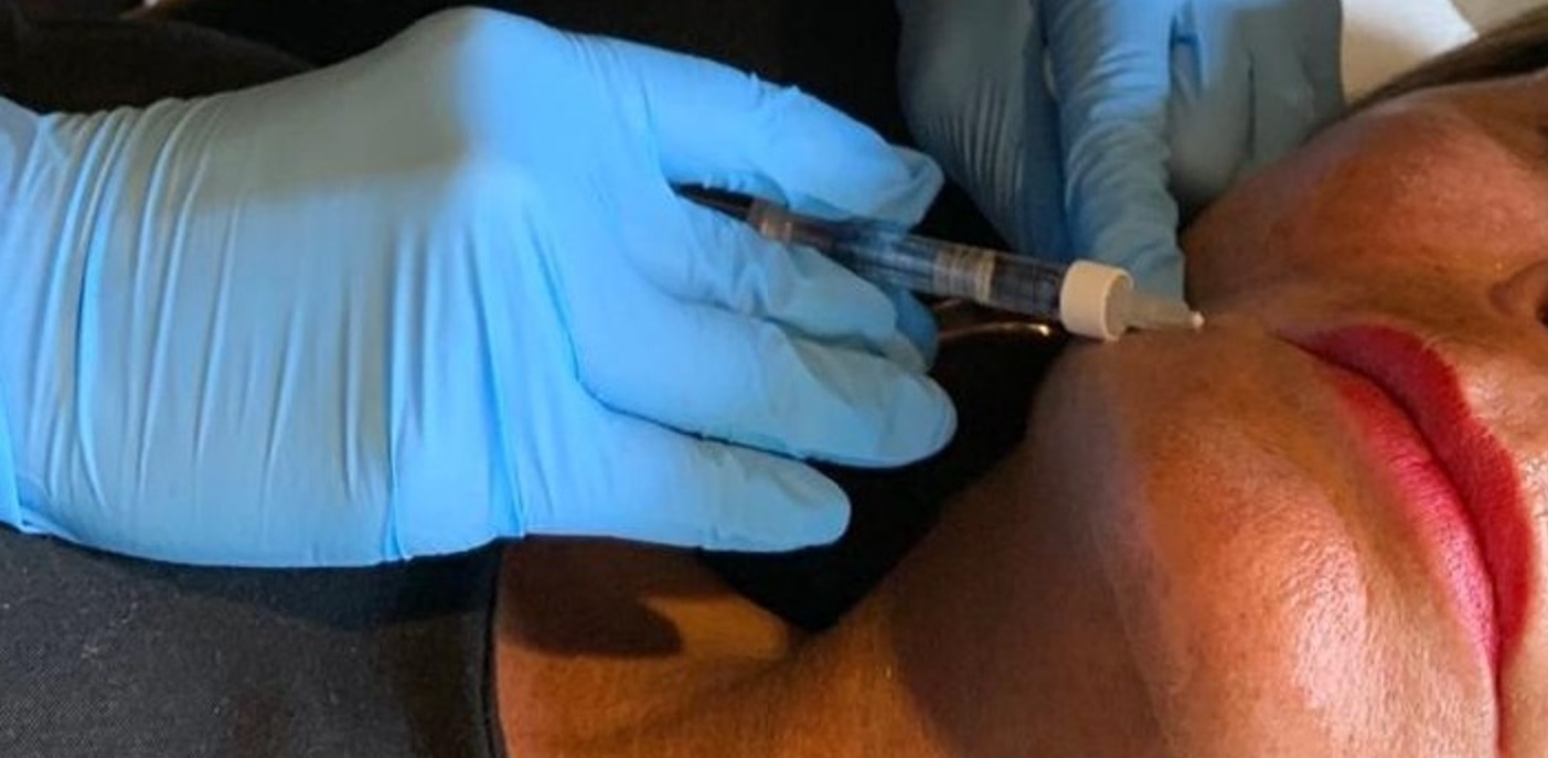 Lip Filler